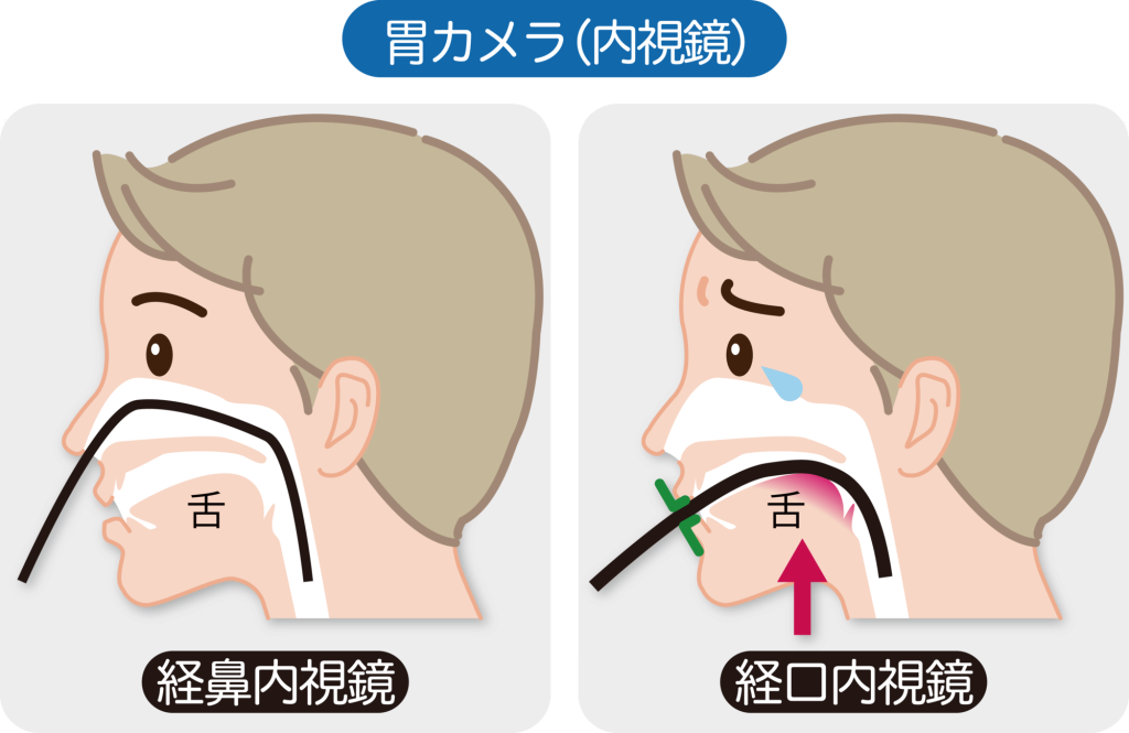 胃カメラ検査は「鼻から（経鼻）」と「口から（経口）」のどちらが楽？