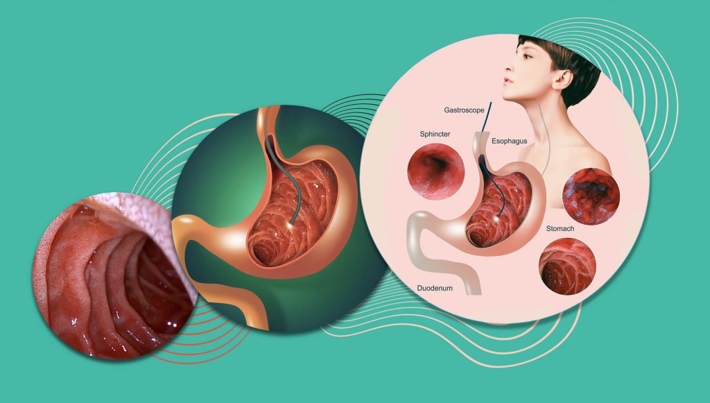 そもそも「胃カメラ」とは？ 検査でわかること