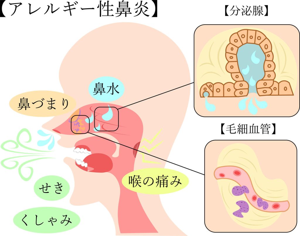 アレルギー性鼻炎とは